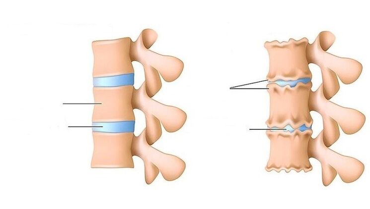 healthy spine and spine affected by osteochondrosis