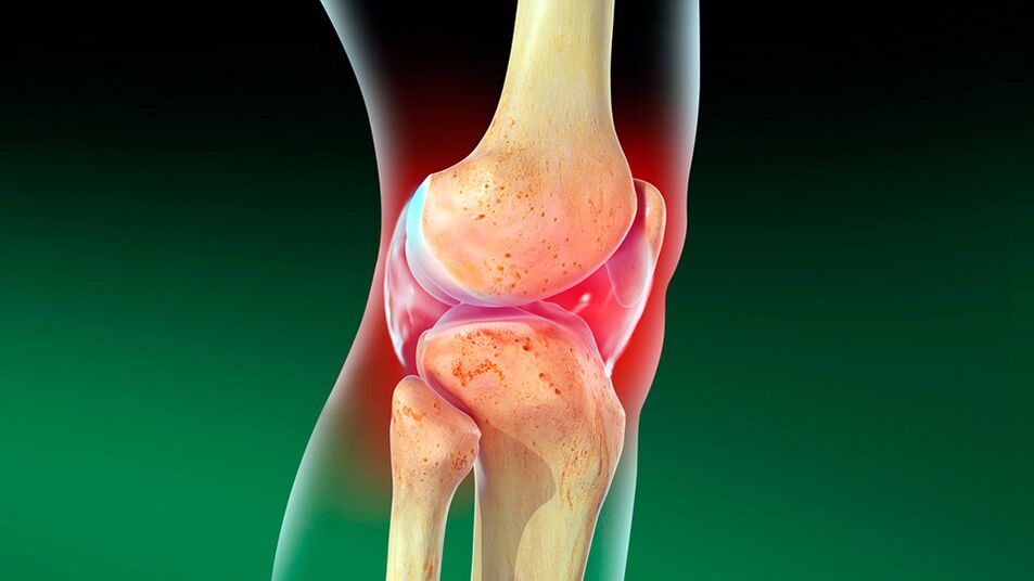 Arthrosis of the knee joint